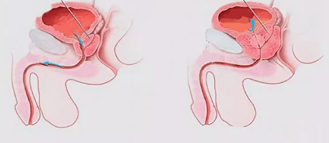 Signs of prostatitis in men