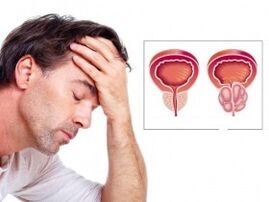 Prostatite in a man