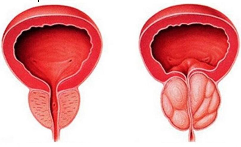 Prostate