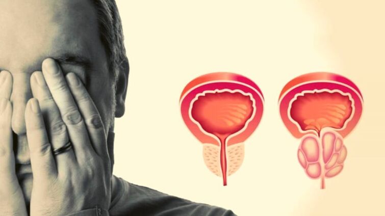 Man has prostatitis