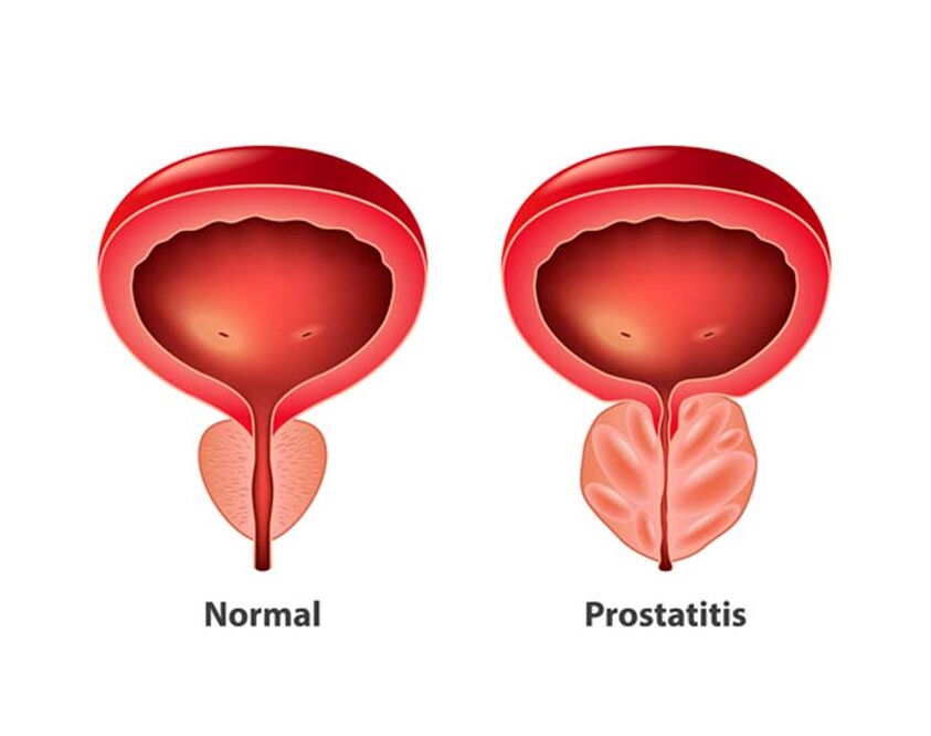 A normal and inflammatory prostate
