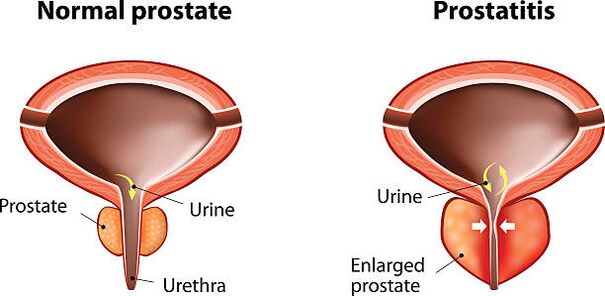 A normal and inflammatory prostate
