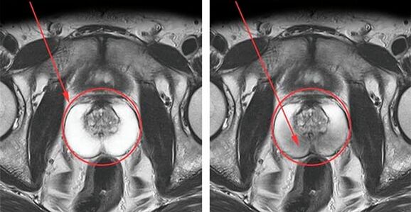 Normal prostate (left) and inflammation of the prostate with prostatitis (right)